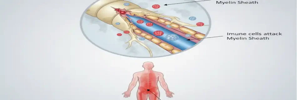 Exploring the 4 Types of Guillain-BarrÃ© Syndrome