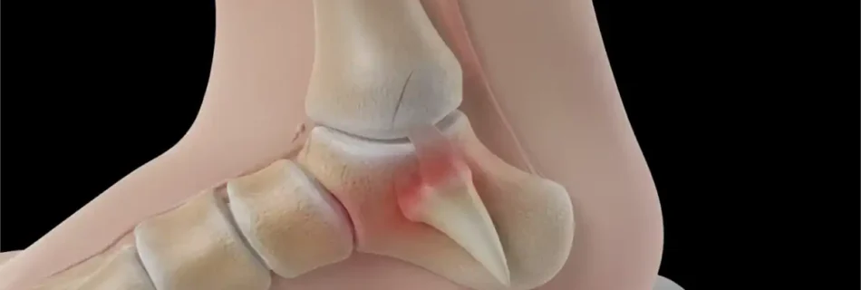 Bone Spur on Heel: Causes, Symptoms, and Effective Treatments