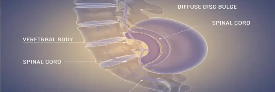 Diffuse Disc Bulge: Understand Causes, Symptoms, and Relief Options