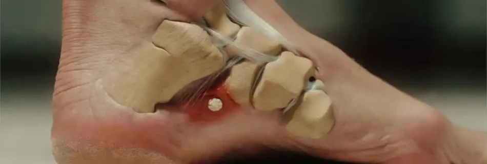 Understanding Heel Spur Symptoms: Causes, Treatment, and Prevention