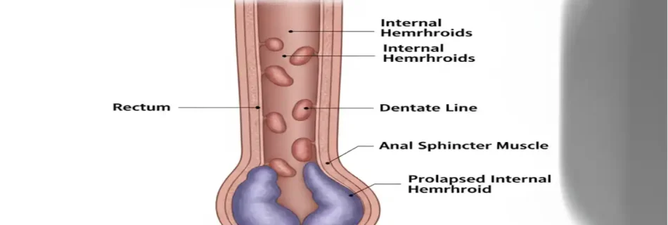 Hemorrhoid How Long to Go Away: Essential Insights