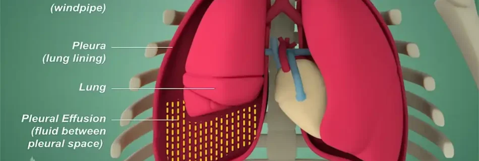 Pleuropericardial Effusion: Causes, Symptoms, Diagnosis, and Treatment