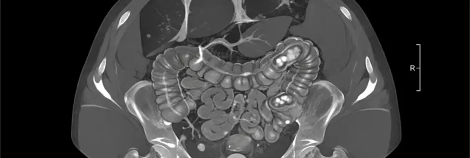 Appendicitis CT: Complete Guide to Diagnosis and Imaging