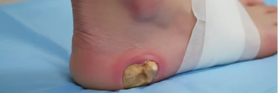 bone spur foot: Complete Guide to Causes, Relief, and Recovery