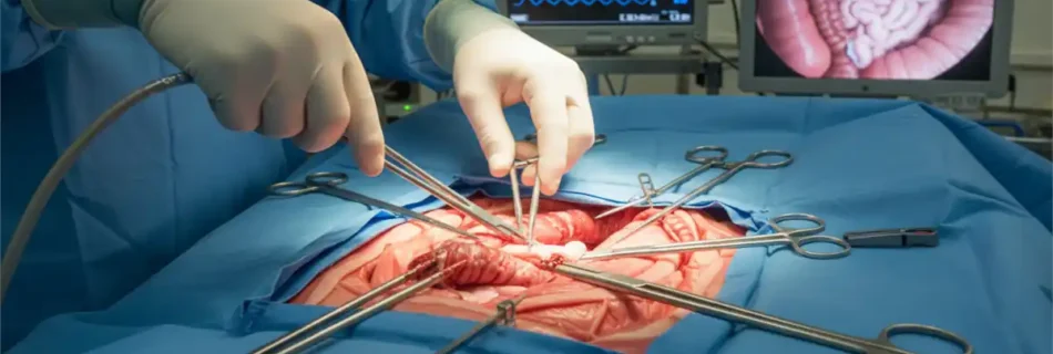 diverticulitis surgery: 7 Powerful Proven Tips