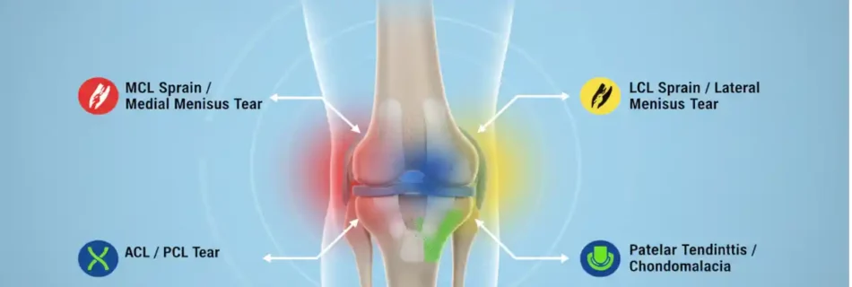Twisted Knee Symptoms: Complete Guide to Signs, Causes, and Recovery
