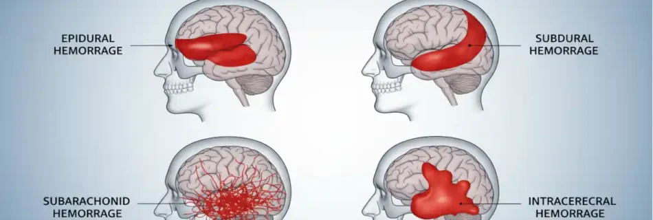 What Are the Chances of Surviving a Brain Bleed – Critical Facts and Hopeful Outcomes