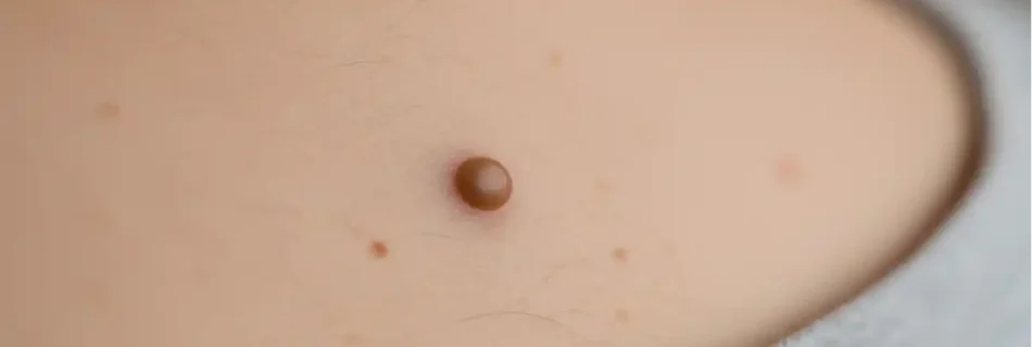 Benign Mole: Causes, Symptoms, Diagnosis, Treatment, and Prevention Guide