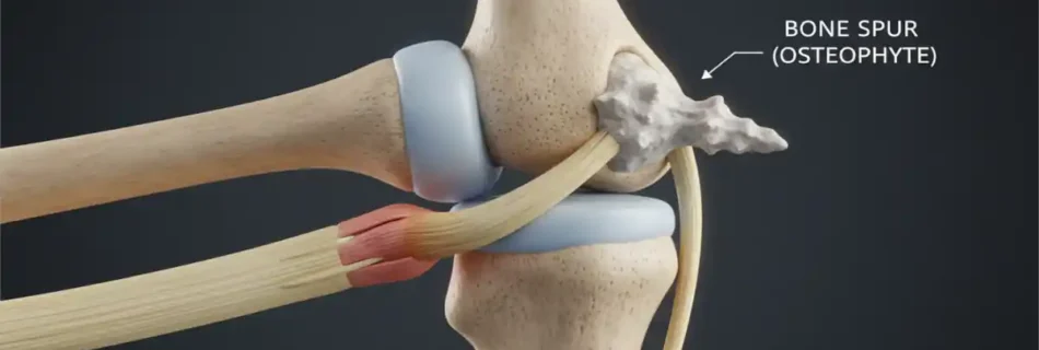 Bone Spur Treatment: Effective Ways to Relieve Pain and Restore Mobility