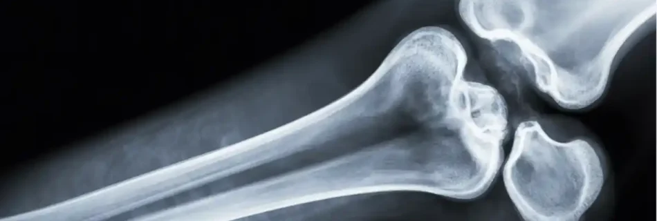 displaced fracture: Causes, Symptoms, Diagnosis, Treatment, and Recovery