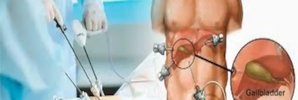 How Long Is Gallbladder Surgery? Complete Recovery and Procedure Guide