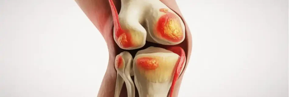 Sprained Knee Symptoms: A Complete Guide to Recognition, Treatment, and Recovery