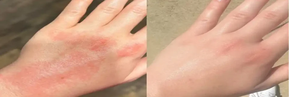 Does Eczema Go Away? Understanding Long-Term Management and Recovery