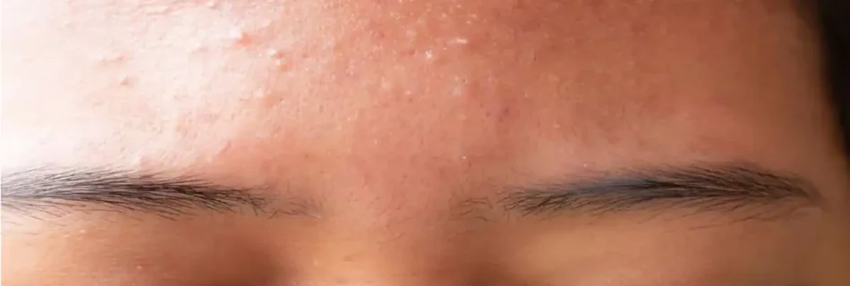 How to Get Rid of Forehead Acne: A Complete Guide to Clearer Skin