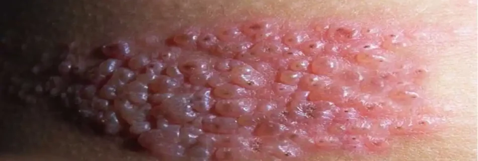 Internal Shingles: Symptoms, Causes, Diagnosis, Treatment, and Recovery