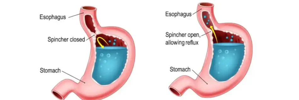 Is GERD Curable? A Complete Guide to Managing Acid Reflux Effectively