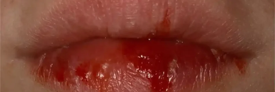 Blood Bubble in Mouth: Causes, Symptoms, Treatment, and Prevention